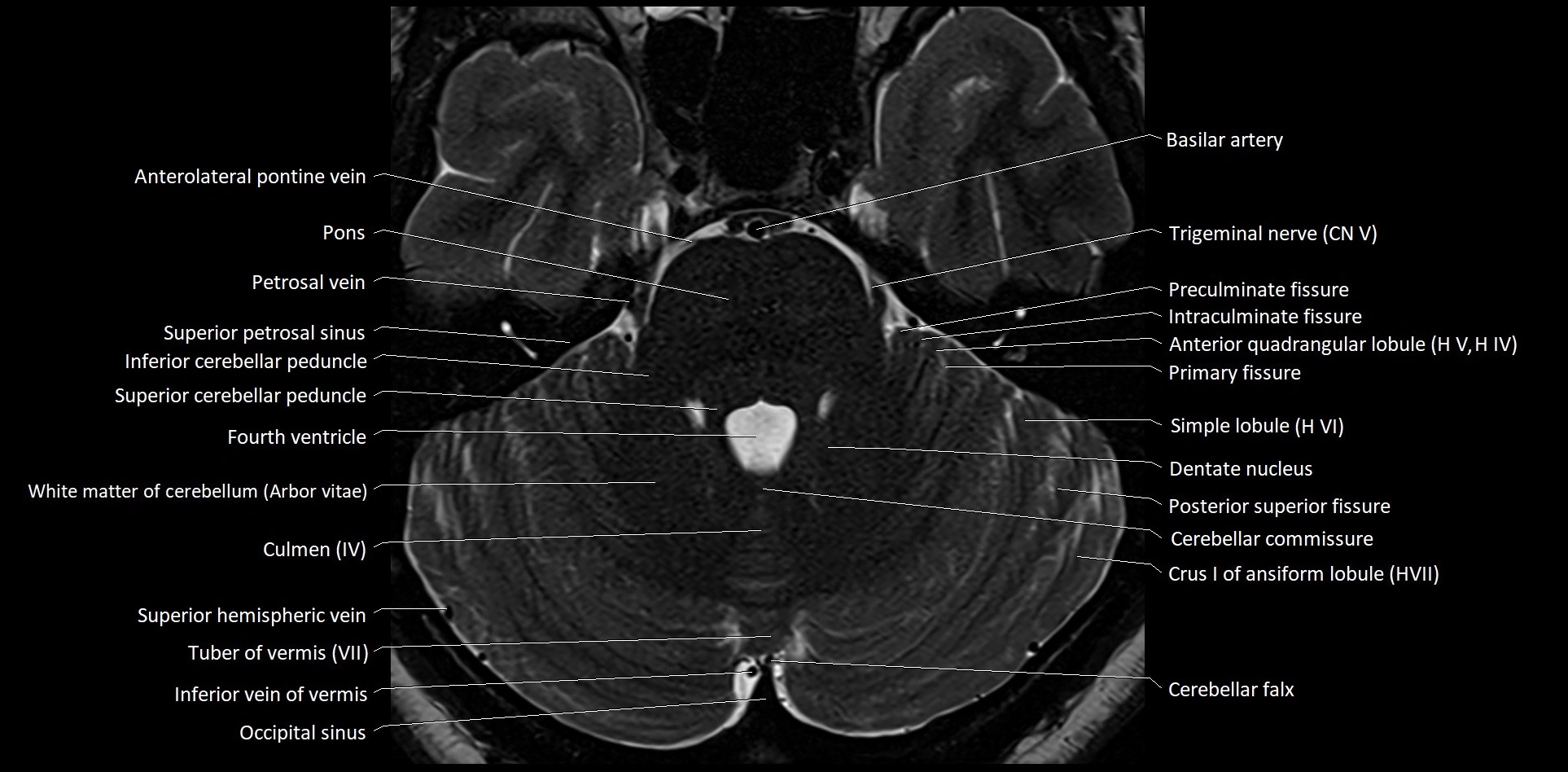 MRI Cerebellar anatomy High-resolution labelled 3T MRI image 16.webp